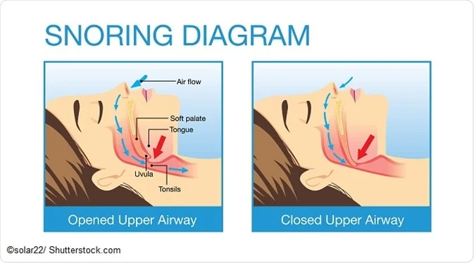 Snoring.webp